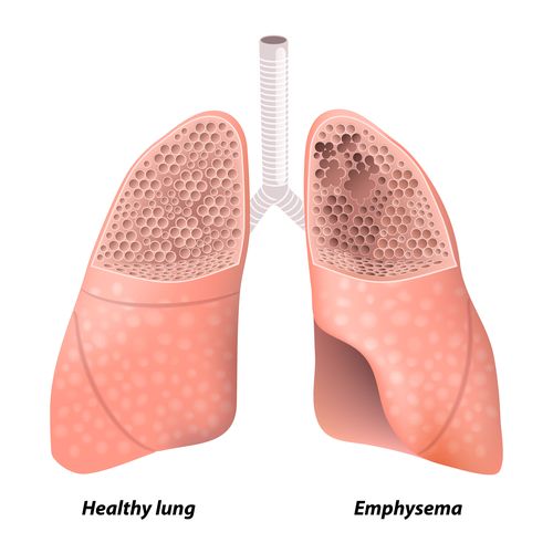 Эмфизема лёгких