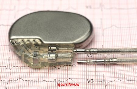 Электрические приборы и больное сердце: как обращаться с кардиостимулятором?