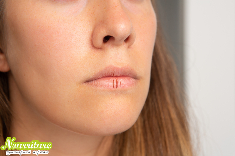 Вертикальные трещины на губах