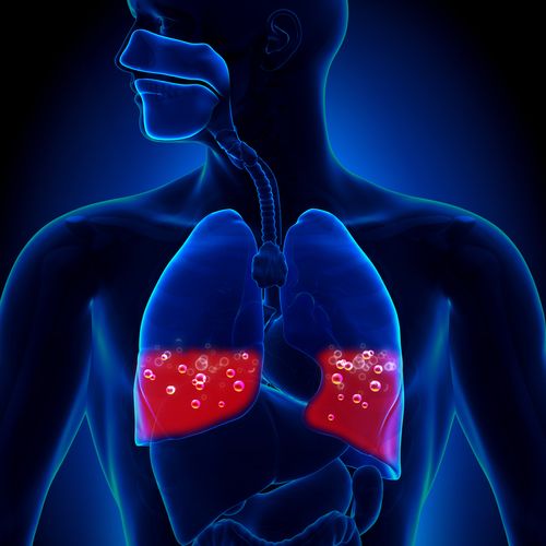 Сердечная астма и отек легких