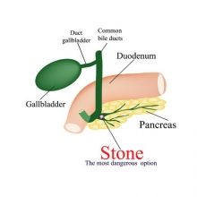 Камнеобразование в поджелудочной железе (образование конкрементов, или образование камней, в поджелудочной железе)