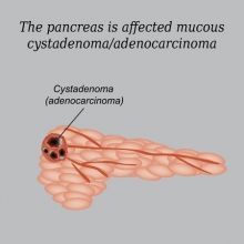 Киста поджелудочной железы: посттравматические кисты поджелудочной железы, панкреатические кисты