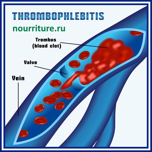 Trombophlebitis.jpg