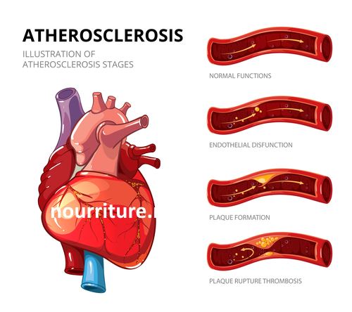 Aterosklerosis.jpg