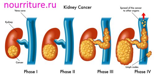Kidney-cancer1.jpg